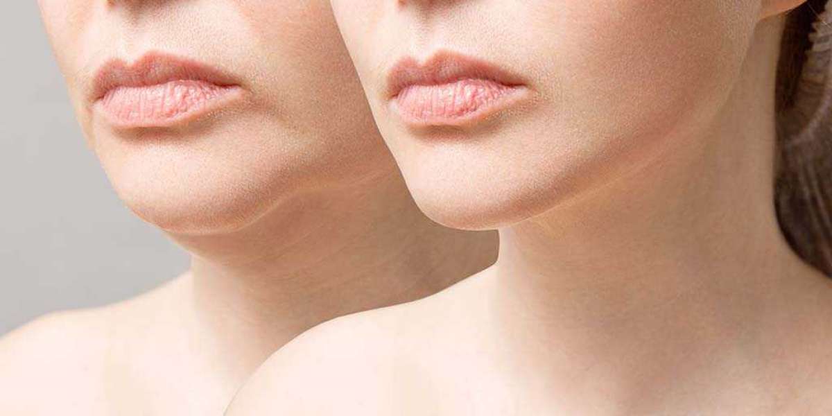 Subtle yet Striking: How Dermal Fillers Enhance Your Natural Beauty