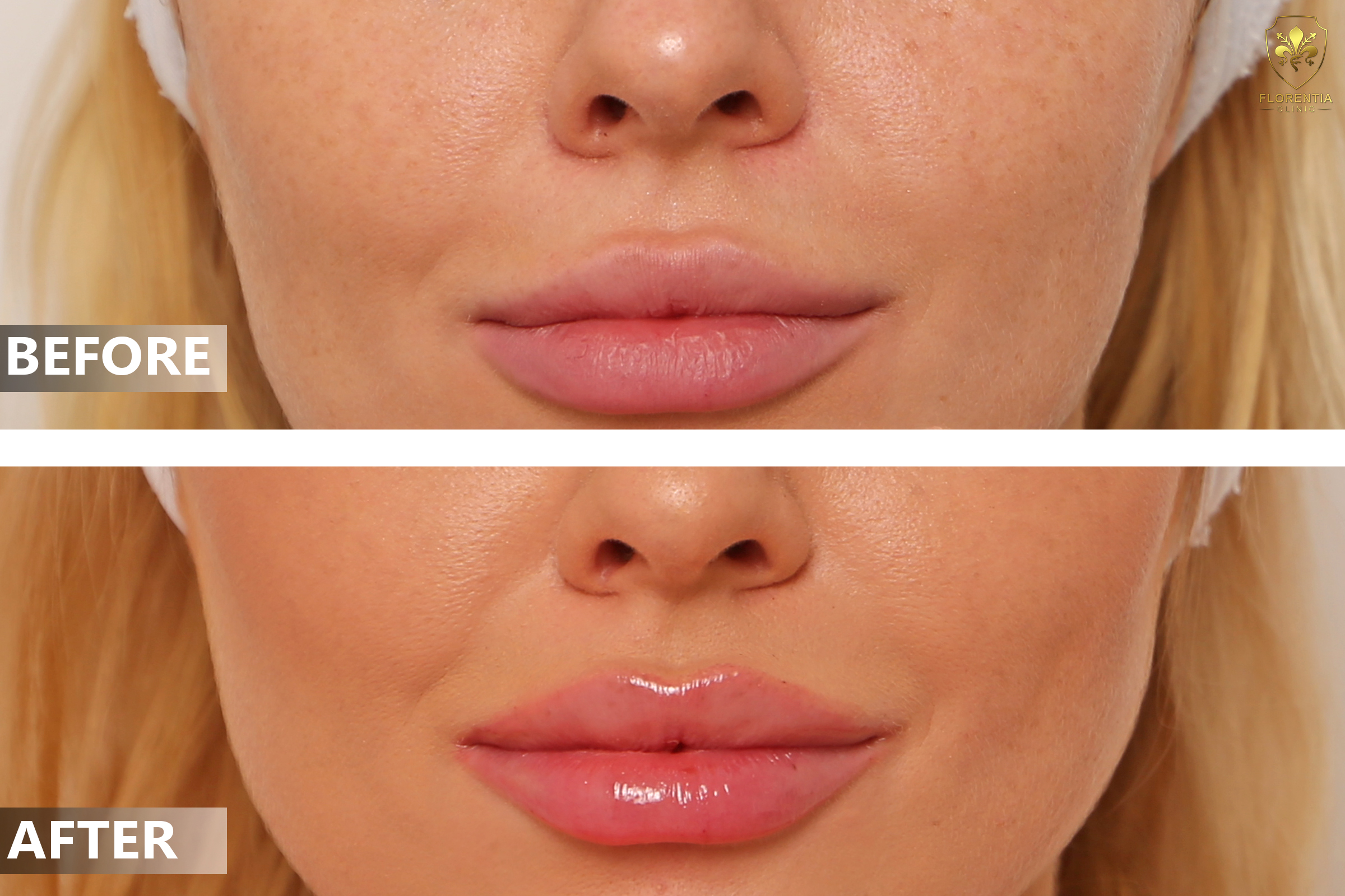 Best Lip Fillers in Dubai - Lip Augmentation Dubai