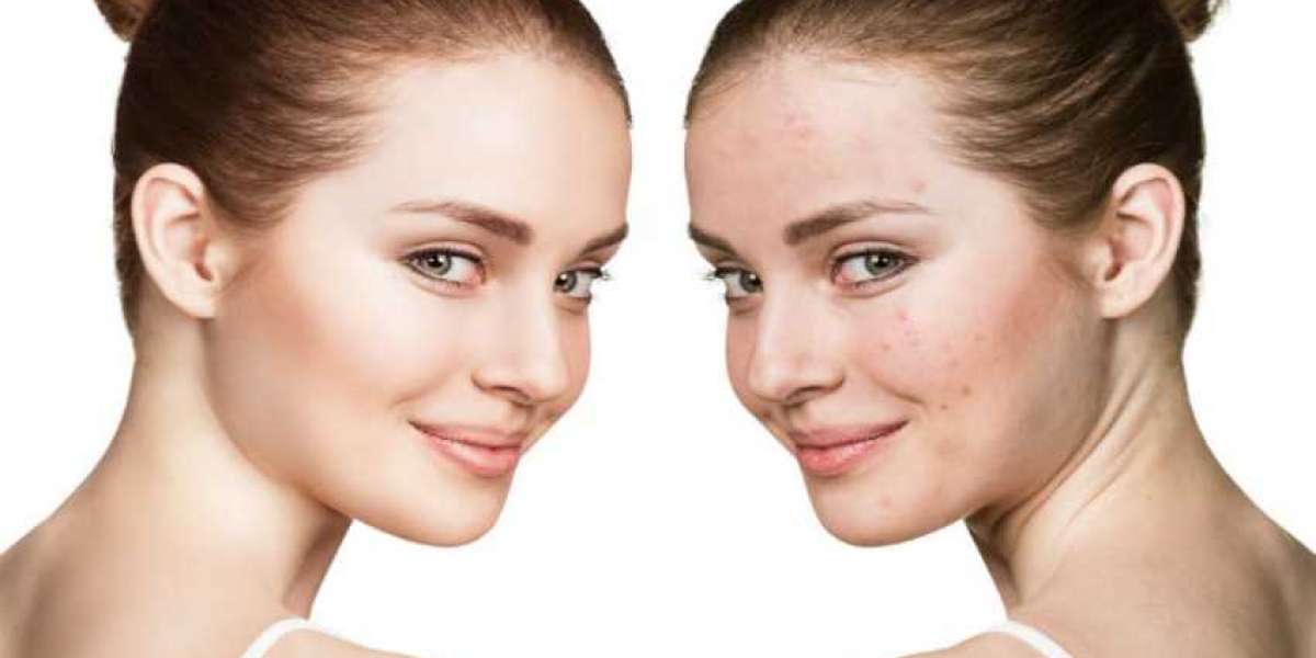 Isotretinoin 20mg capsule use for Acne.