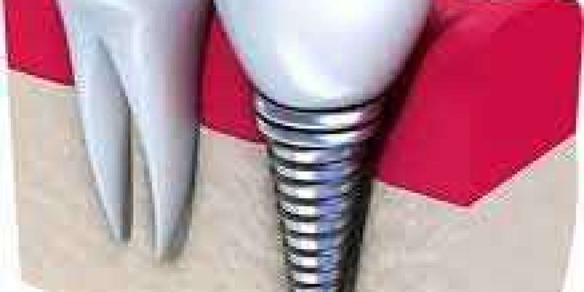The Method of Dental Implant Positioning