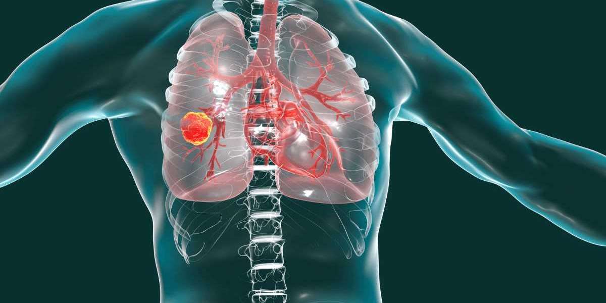 Lung Cancer Is Common Across India