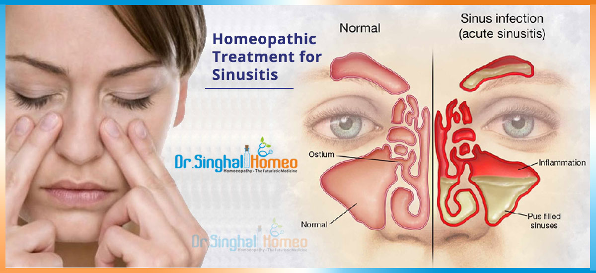 Get Effective Homeopathic Treatment for Sinusitis at the Best Cost