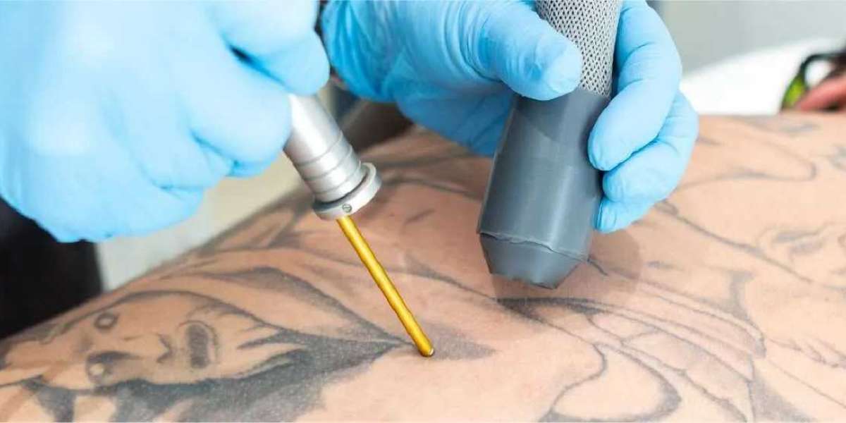 Fading Ink Around the World: Tattoo Removal Market Trends by Region