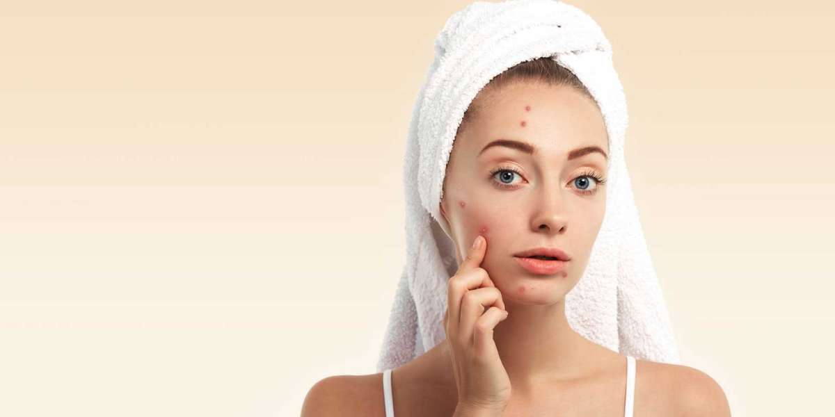 What causes acne and how to get rid of them with effective treatments?
