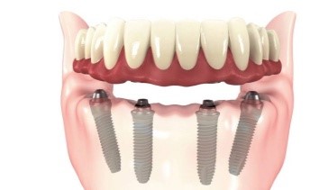 Best All On 4 Implant In Delhi | 32 Strong Dental | Dr. Pooja Jain