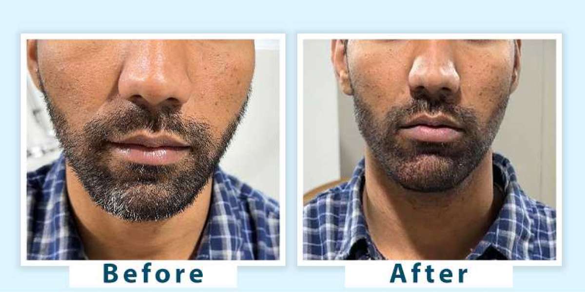 How to Remove Grey Beard Naturally and Permanently